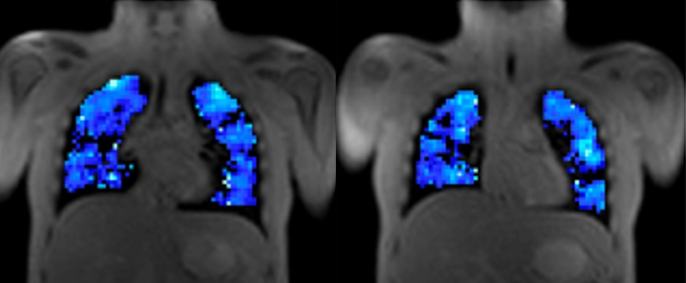 Ventilation maps from oxygen-enhanced MRI