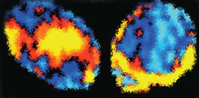 Tumour hypoxia imaging example