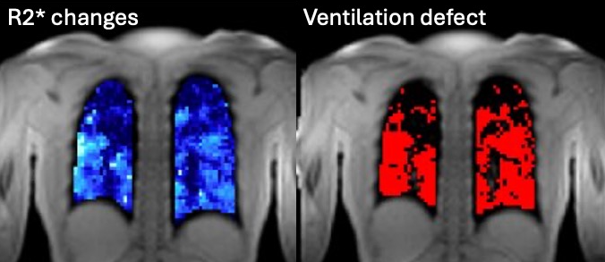 Ventilation maps from oxygen-enhanced MRI of the lung
